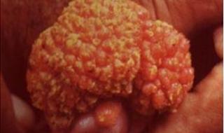 男性湿锐尖初期图片